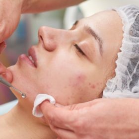 Teenager Facial Treatment (Akne-Behandlung)